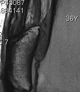 Quadriceps Tendinosis 2